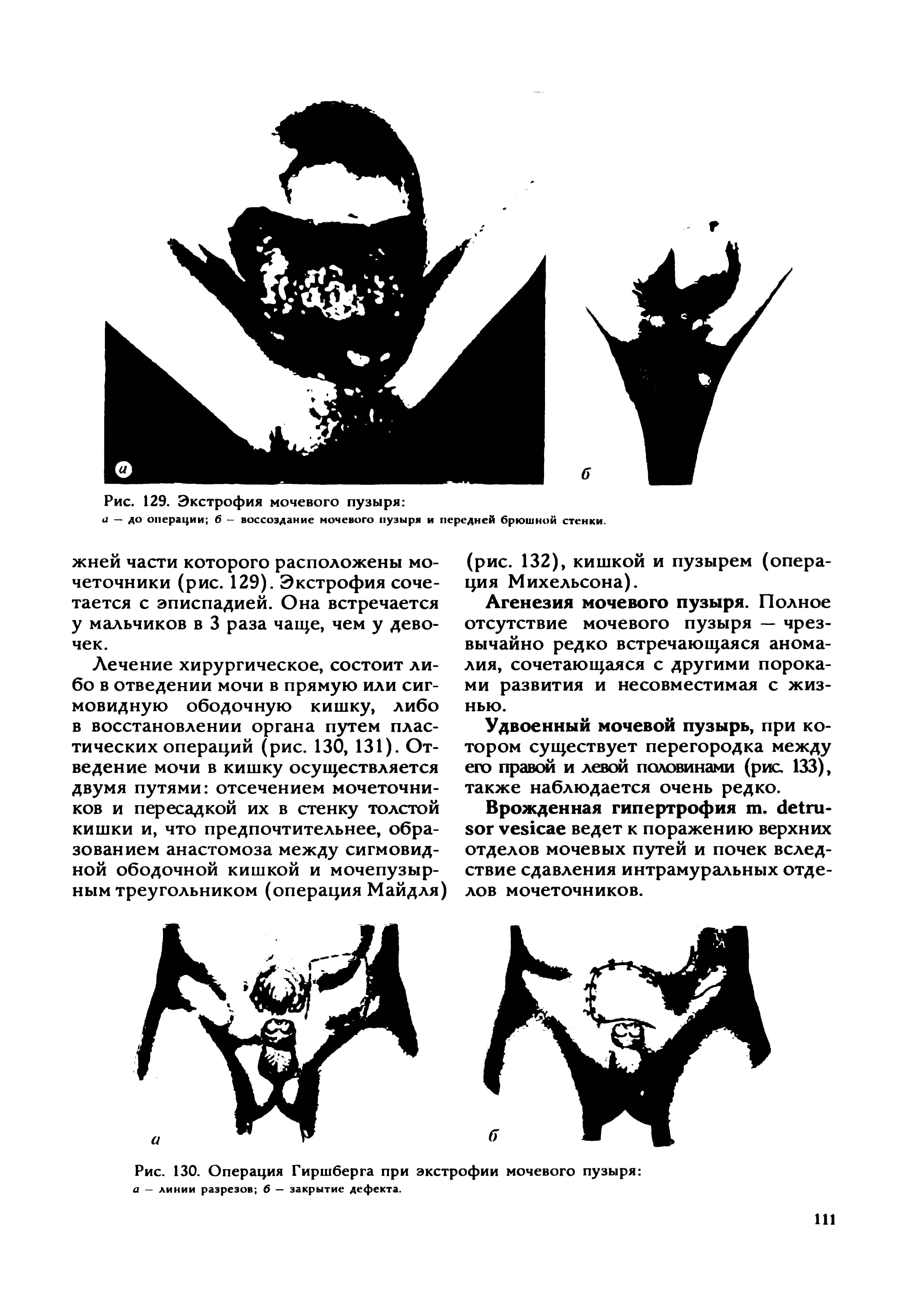 Рис. 130. Операция Гиршберга при экстрофии мочевого пузыря а — линии разрезов 6 — закрытие дефекта.